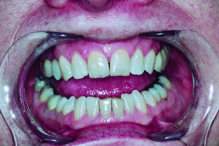 Gums in a persons' mouth.