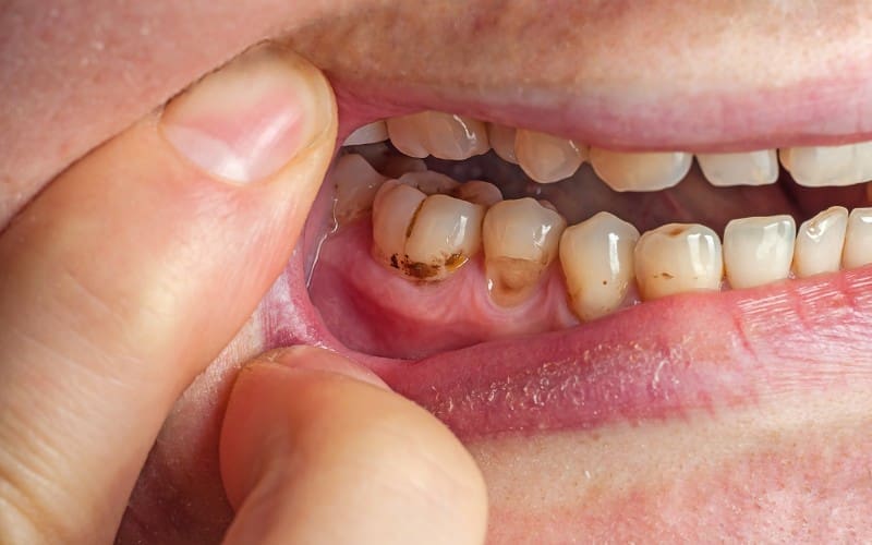 dental filling for tooth decay