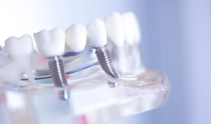 Dental Bridges Edmonton - Clean Smiles