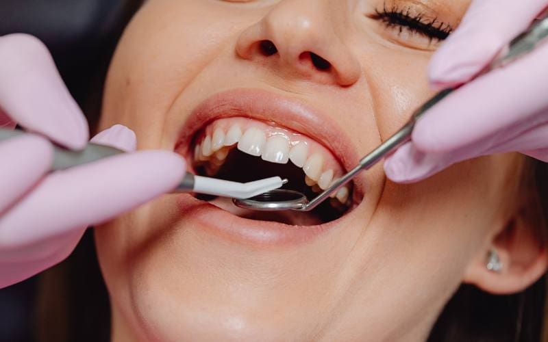 AIRFLOW® Dental Cleaning - Clean Smiles Dental