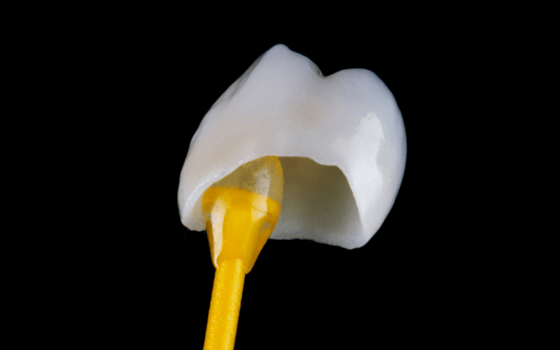 Crowns Clean Smiles Edmonton