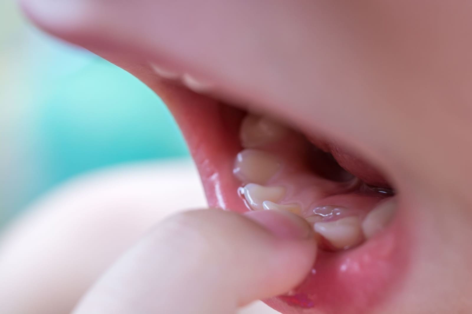 Close-up of a child's open mouth and pink lips, showing a lower back primary molar tooth (baby tooth) with a small, clear orthodontic bracket or composite buildup on it. A finger gently touches the lip near the tooth. The adjacent teeth appear healthy, and the image may show a primary tooth that hasn't fallen out yet with the permanent tooth erupting behind it, or a tooth that is being monitored/treated.