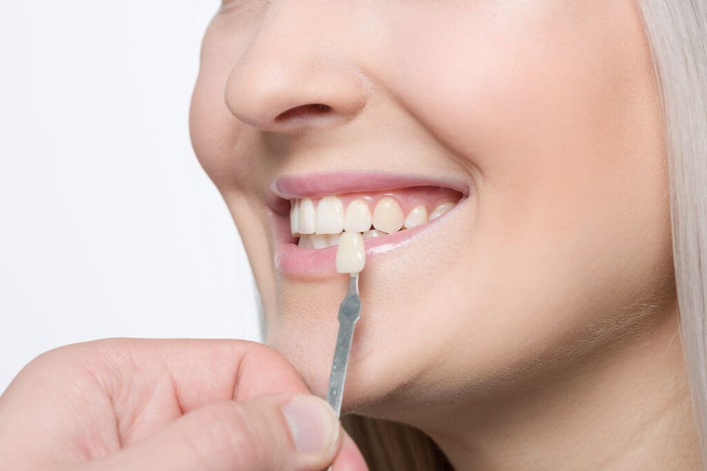Side view close-up of a smiling female patient with her natural teeth exposed, as a dentist's hand holds a single porcelain tooth sample on a metal shade guide next to her mouth to select the perfect color match for a dental veneer or crown.