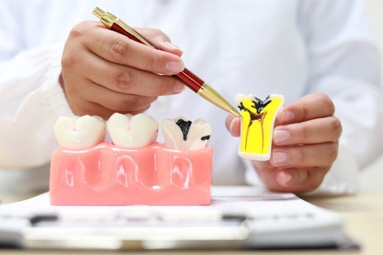 Close-up of a dentist or dental professional in a white coat using a pen to point at a cross-section model illustrating severe tooth decay and a root canal infection. The model shows a deep cavity and yellow-orange pus/infection in the root structure, contrasting with a separate model of healthy teeth. Used for patient education on dental hygiene, cavities, and endodontic treatment.