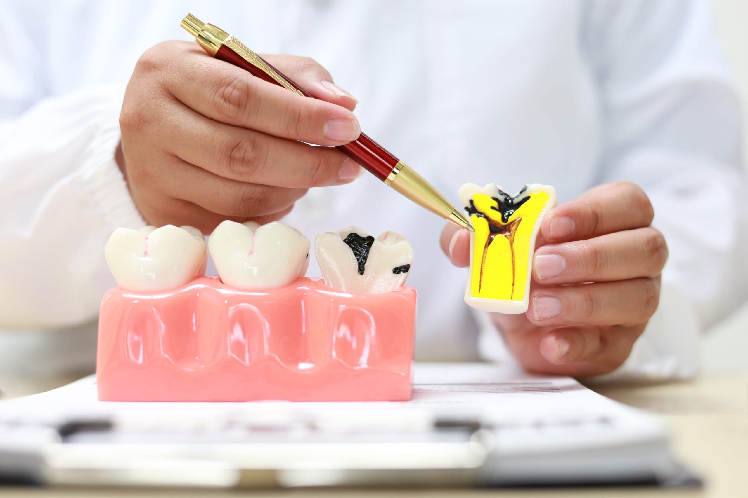 Close-up of a dentist or dental professional in a white coat using a pen to point at a cross-section model illustrating severe tooth decay and a root canal infection. The model shows a deep cavity and yellow-orange pus/infection in the root structure, contrasting with a separate model of healthy teeth. Used for patient education on dental hygiene, cavities, and endodontic treatment.