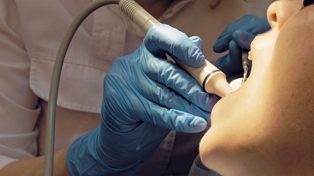 Close-up of a patient receiving professional dental care, showing a dental hygienist's gloved hands (wearing blue nitrile gloves) operating an ultrasonic scaler tool on the patient's molar. The equipment is used for a deep cleaning, scaling, and tartar removal procedure. Illustrates modern preventative dentistry and routine hygiene appointments.