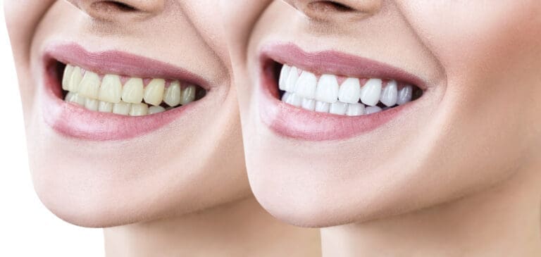 Side-by-side comparison illustrating dramatic cosmetic dentistry results, featuring a woman's smile with discolored teeth and a final brilliant, whiter smile after bleaching.