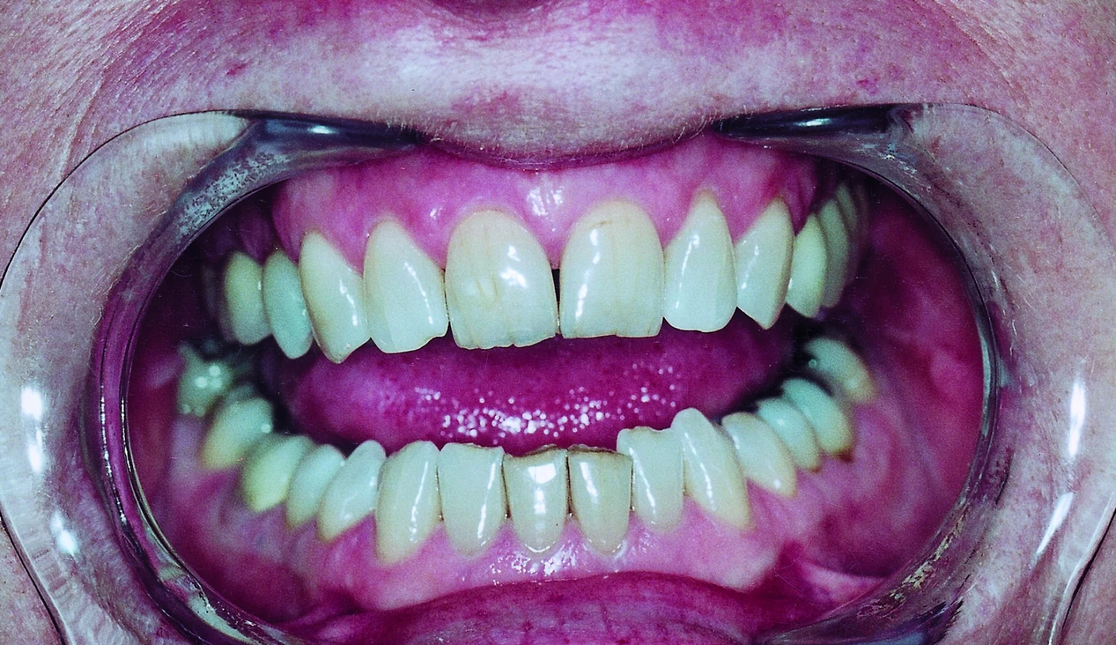 Gums in a persons' mouth.